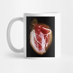 Coloured arteriogram of arteries of healthy heart (P216/0300) Mug